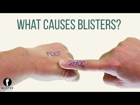 What Causes Blisters On Feet?