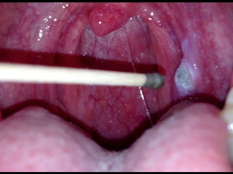 silver nitrate &#039;burning&#039; of a canker sore